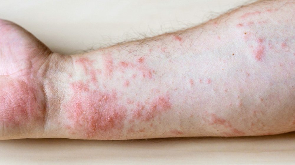 Contact-dermatitis-of-the-arm-body19.jpg